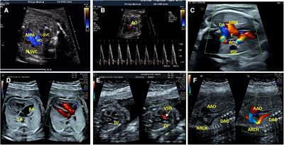 Prenatal phenotype features and genetic etiology of the Williams-Beuren syndrome and literature review